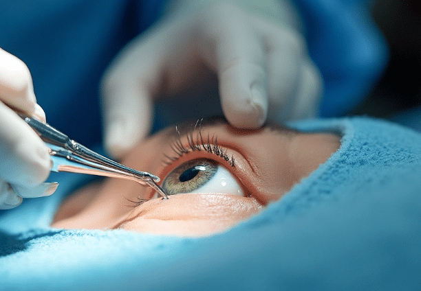 Lasik Eye Surgery
